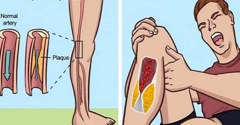 How To Thin Blood Clots Naturally