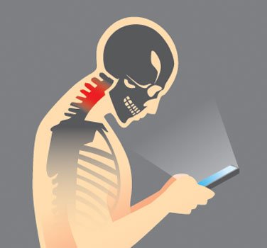 texting causes forward head posture syndrome