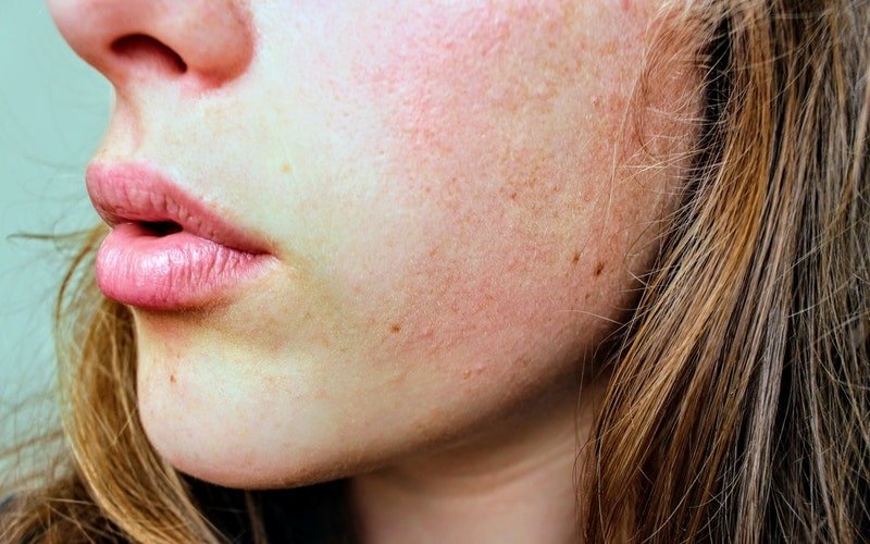 Skin with eczema and acne