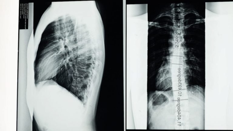 what is scoliosis