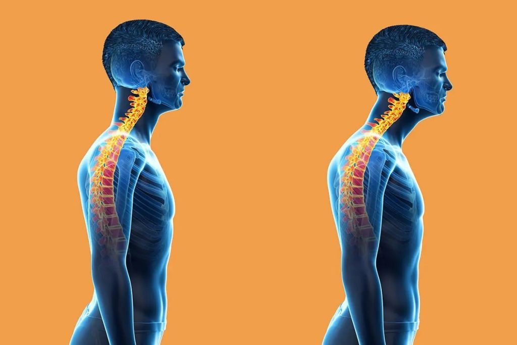 Is Forward Head Posture Correctable?