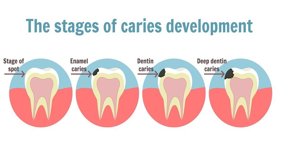 The Stages of Caries Development