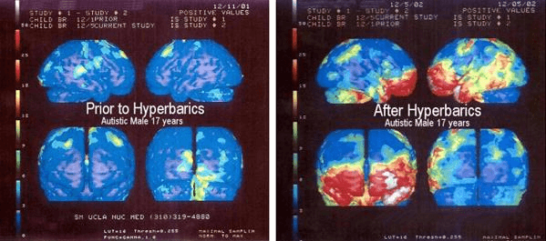 There is a great deal of research indicating the efficacy of HBOT for treating Autism spectrum disorders, with changes in regional blood flow and function within the cortices of individuals being measured using SPECT and PET scans. This research has found that bilateral temporal lobe hypoperfusion is present in a significant number of autistic children.