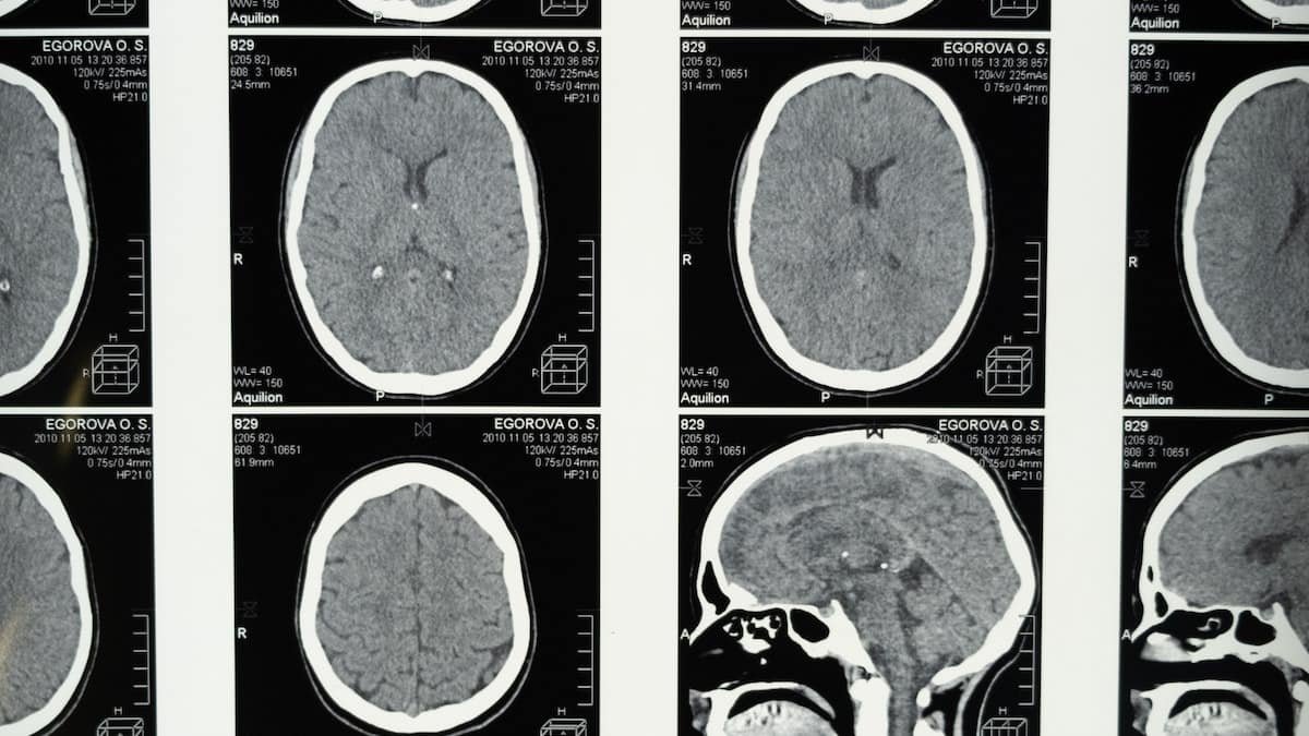 How hyperbaric oxygen therapy helps with brain injury?