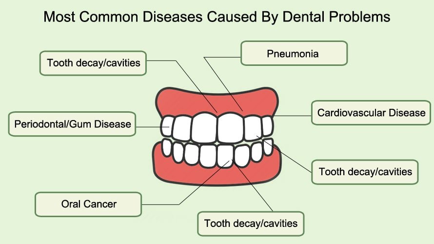 Most Common Diseases caused by Dental Problems