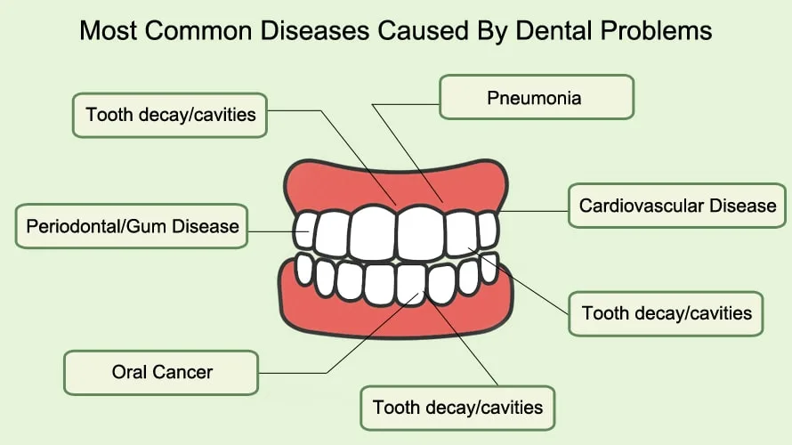 Most Common Diseases caused by Dental Problems