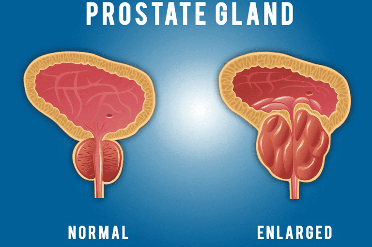 13 Best Foods for Prostate Health: Eat Your Way to a Healthy Prostate