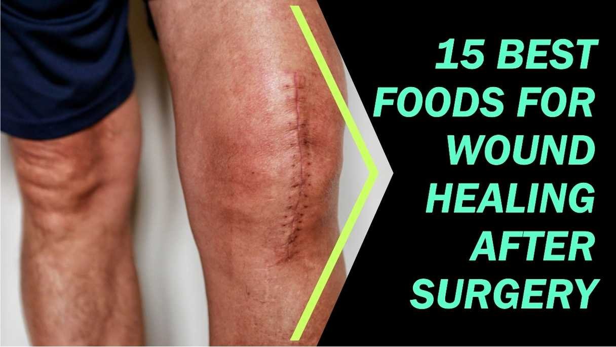 Best Foods For Wound Healing After Surgery