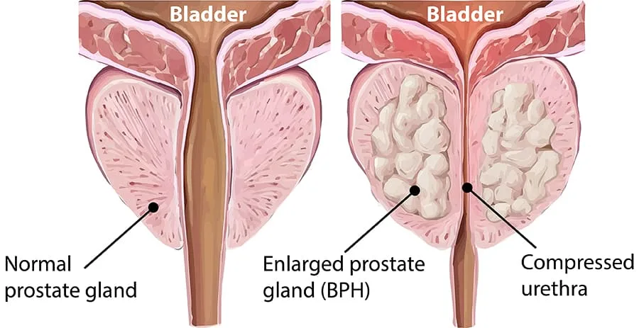 Illustration of swollen prostate gland with compressed urethra