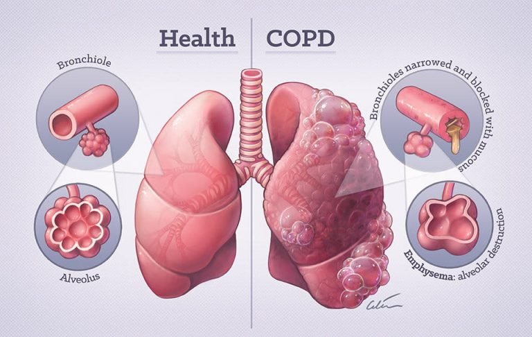 Hyperbaric Oxygen Therapy for COPD: What Expert Say?