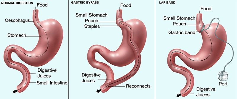 Human digestive systems: a normal system (left), gastric bypass (centre) and lap band (right)