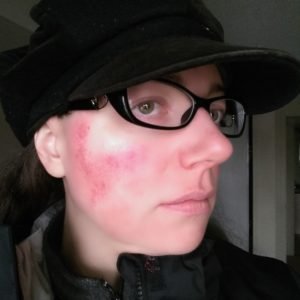 Example of what Julie B. Campbell's rosacea flare ups look like.