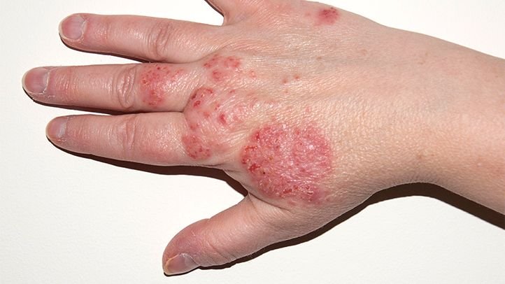 Hand Eczema