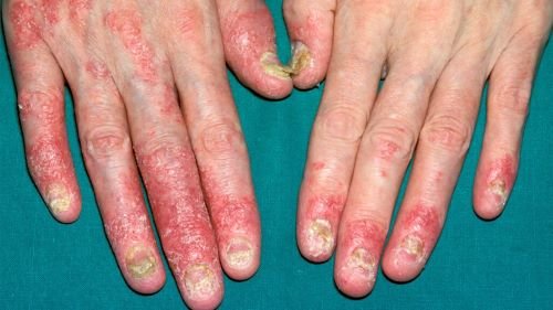 Psoriatic arthritis