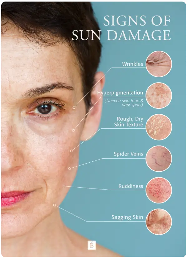 Signs of Sun-Damaged Skin