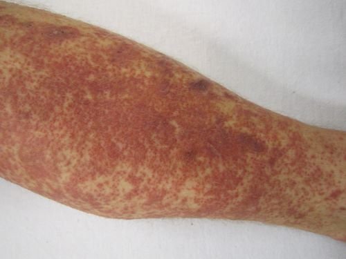 Cutaneous small-vessel vasculitis