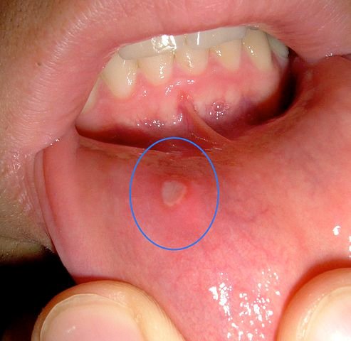 Common Example of a Mouth Ulcer