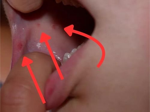 Mouth Ulcer on the inner cheek