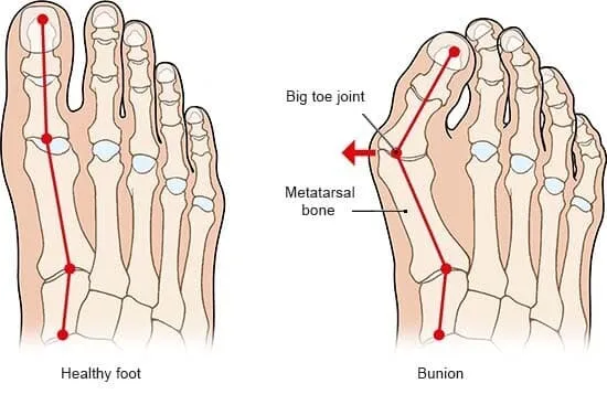 Bunion (Halux Valgus) Illustration