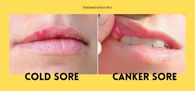 Canker sore vs Cold sore