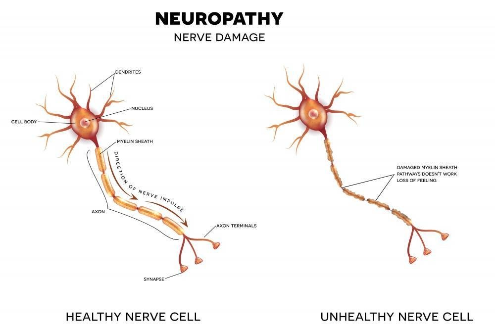 Healthy Nerve vs damaged nerve