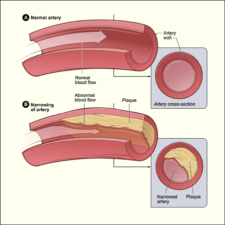 Medical illustration comparing a healthy artery with one exhibiting narrowing, including plaque buildup and abnormal blood flow.