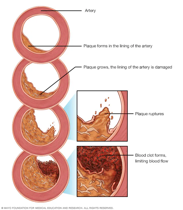 Medical illustration showing progressive artery plaque buildup, culminating in rupture and blood clot formation. 